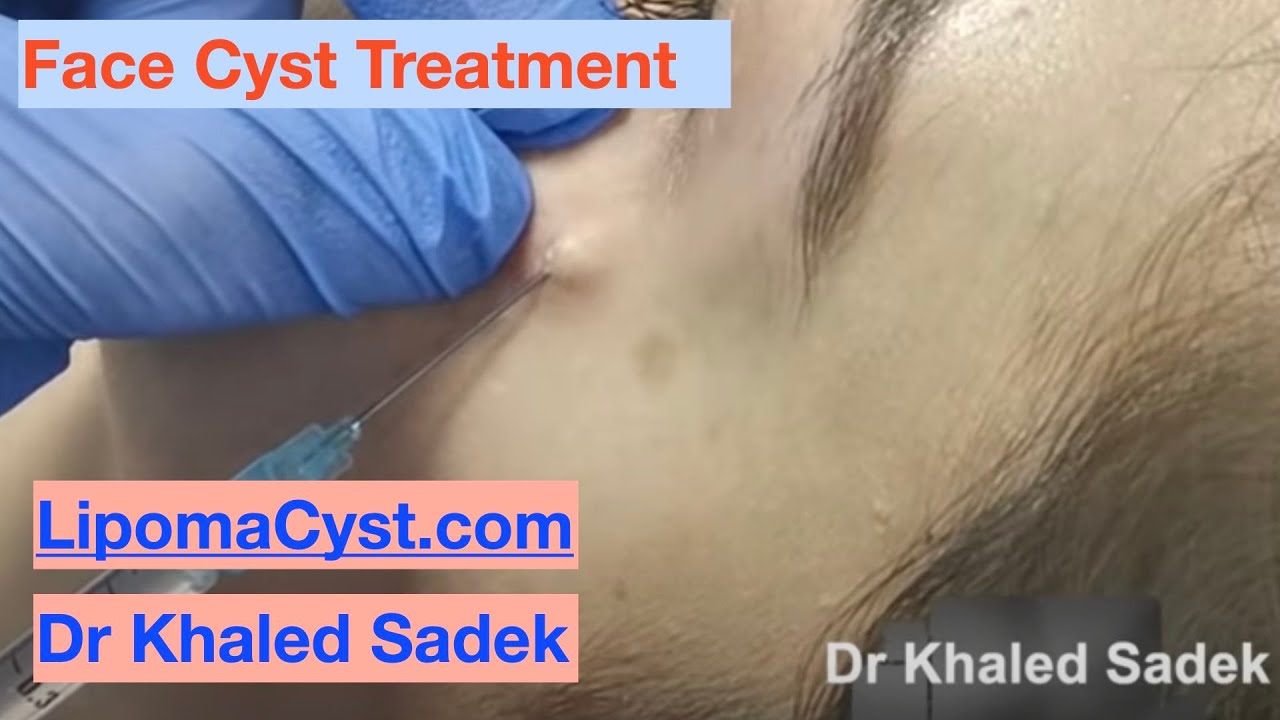Face Cyst Surgery. Dr Khaled Sadek. London Cyst Clinic