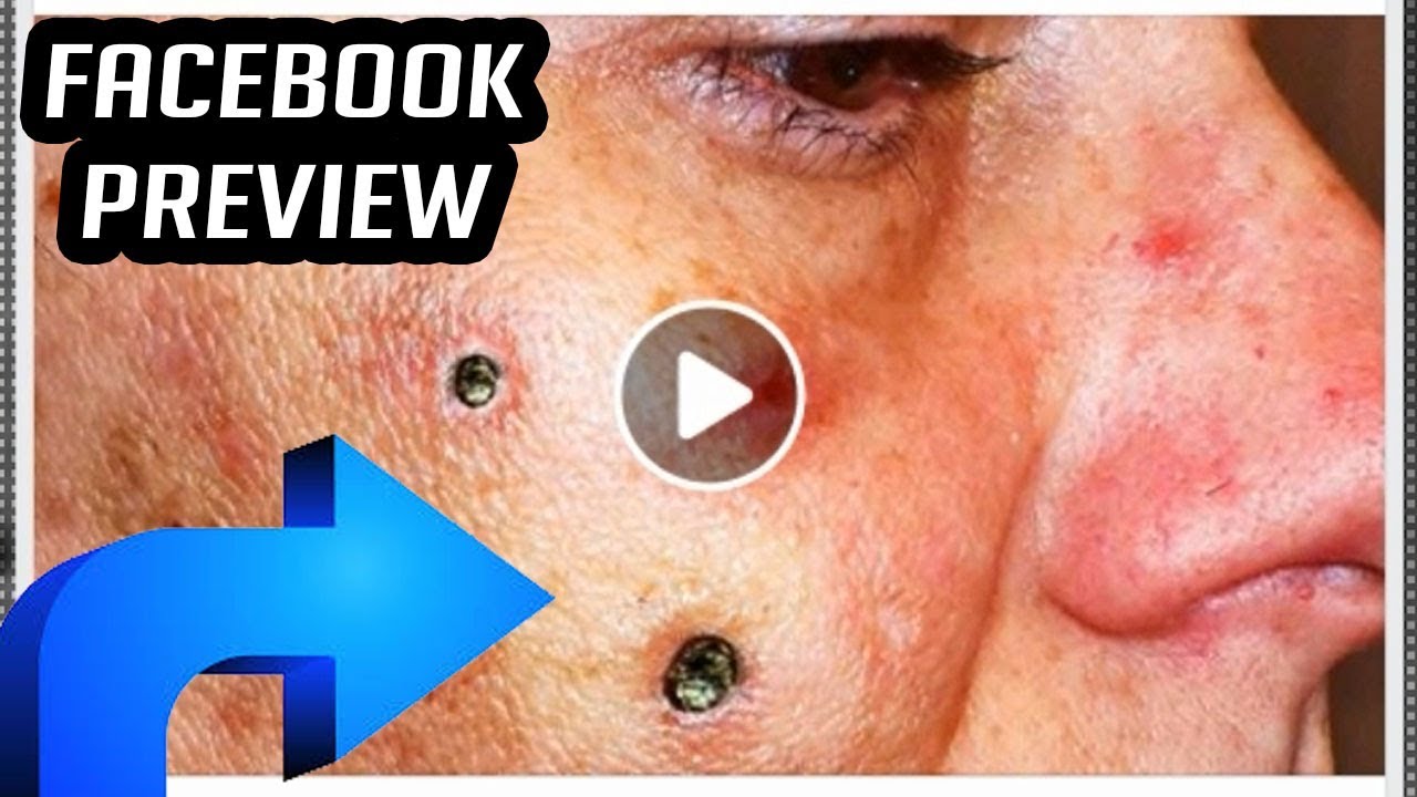 Facebook's Best Cysts, Blackheads, Pimples and Senile Comedones