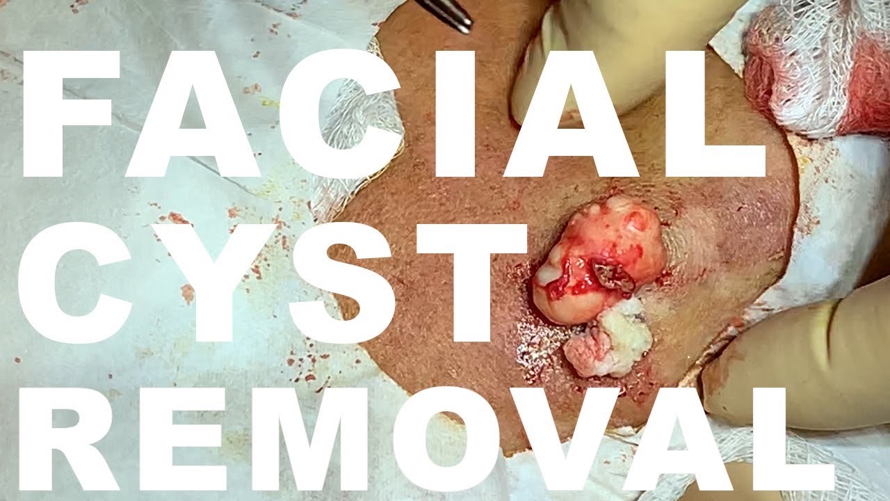 Facial Cyst Removal – Dr. Paul Ruff | West End Plastic Surgery