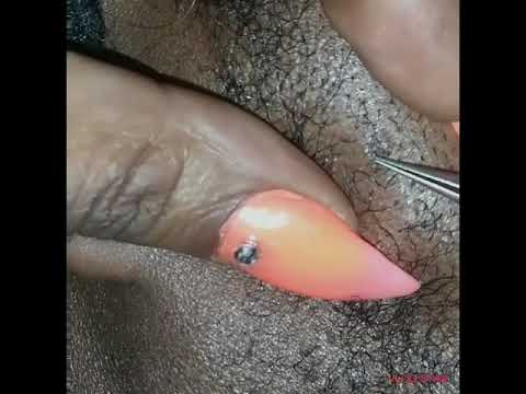 Facial extraction( black head removal)???  #pimplepopping #blackheads #ingrownhairs #extractions