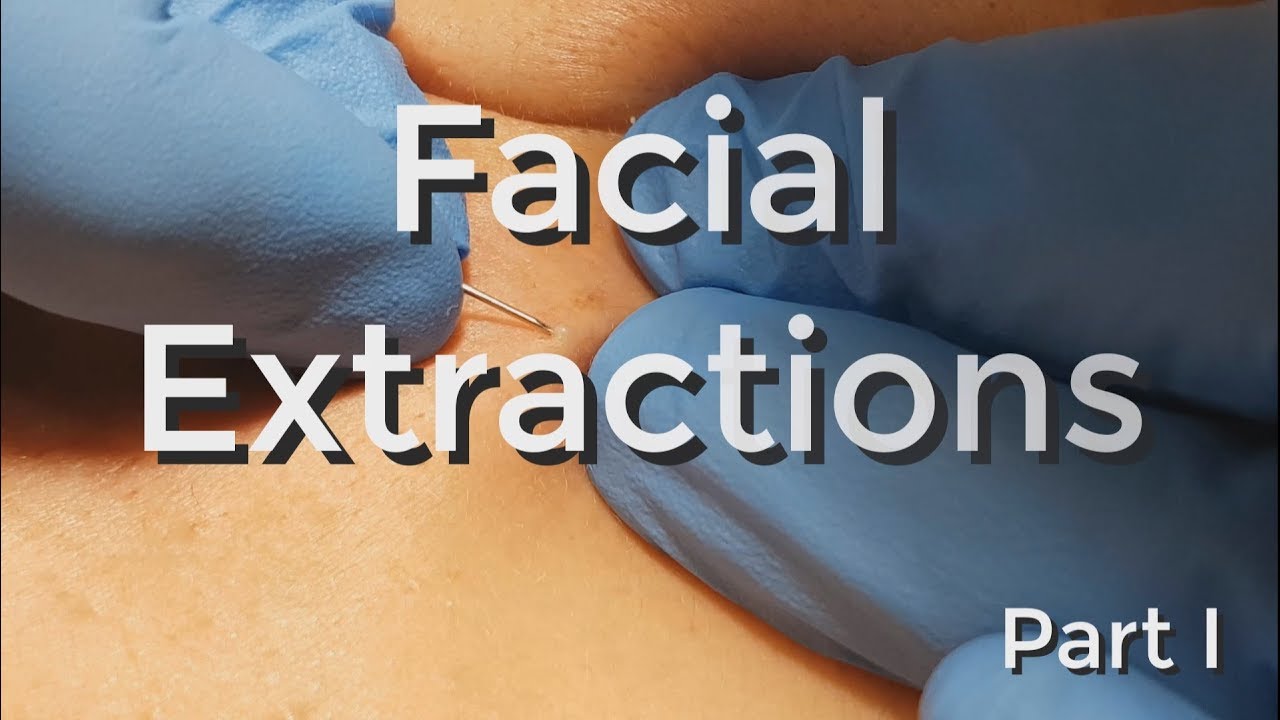 Facial Extractions – Part I