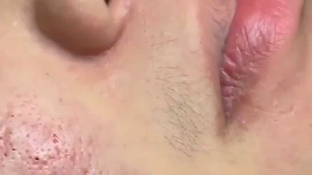 Facial service // satisfying pimple popping