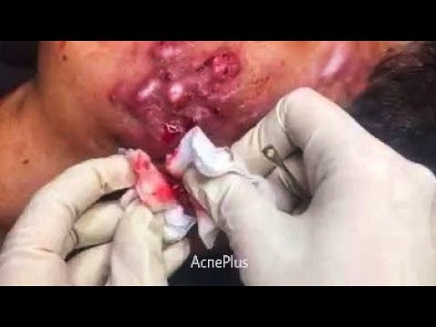 facial treatment for client, pimple popping#13,การดูแลรักษาผิวหน้า (Sep/27/2019)
