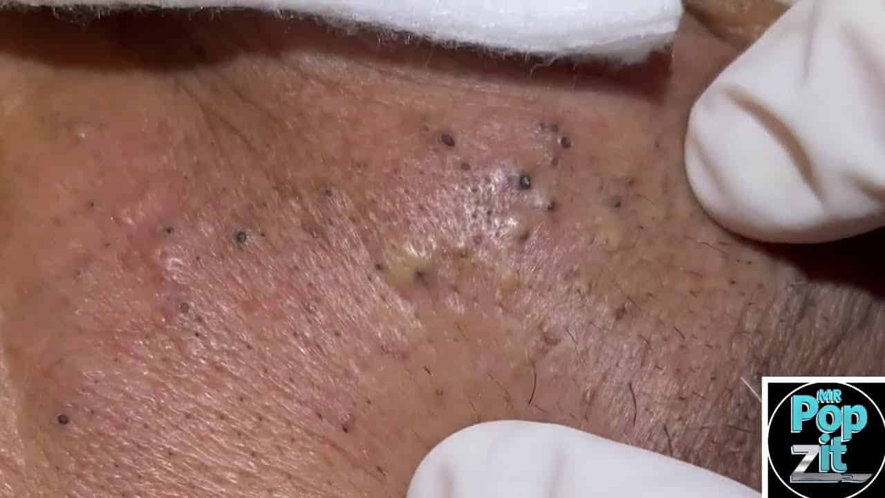 Favre-Racouchot syndrome. Multiple blackheads and whiteheads clustered together. Face Extractions