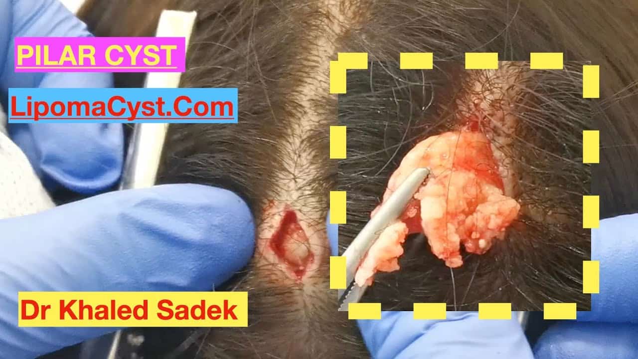 Female Pilar Cyst. Dr Khaled Sadek LipomaCyst.com