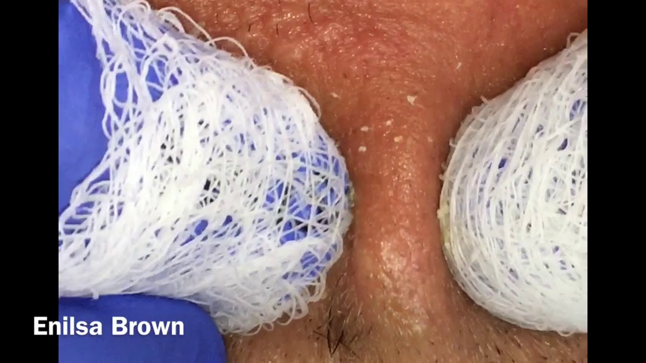 Filament, Ingrown Hair and Blackheads: Short and Sweet Video of Daryl