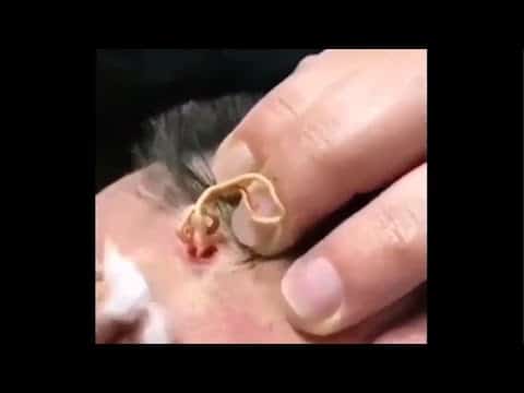 Film Maniac   Most Satisfying Pimple Popping Moments 2020   Part 9