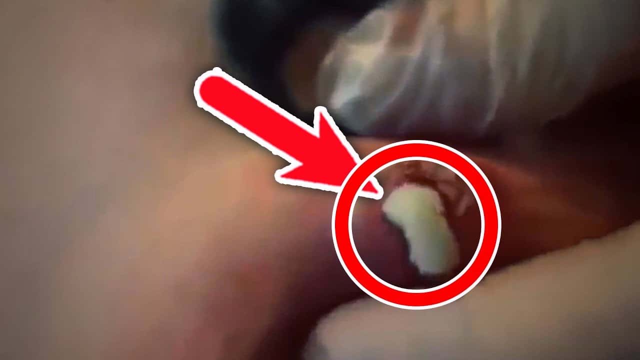 Film Maniac   Most Satisfying Pimple Popping Moments 2020 – Part 5