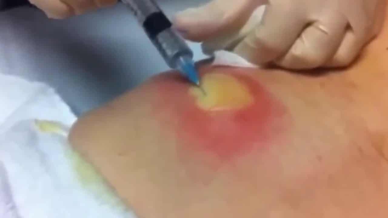 Film Maniac   Most SATISFYING Pimple Popping Moments 2021   Part 13