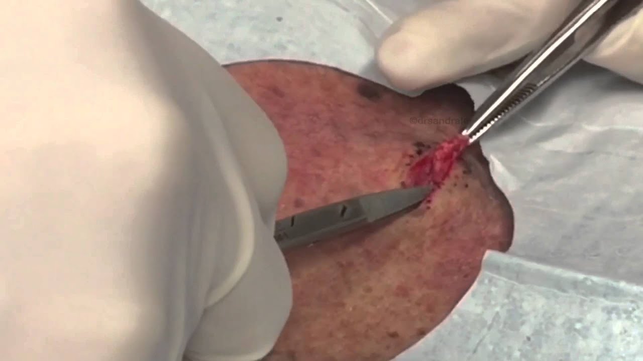 First snapchat vid: Cyst excision on the back.  For medical education- NSFE