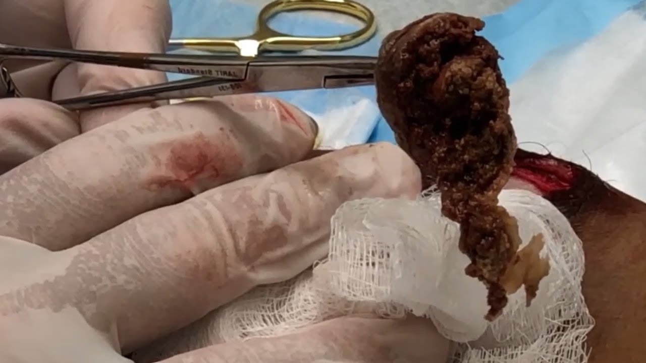Five ENORMOUS Cysts!  Extractions by Dr. Gilmore (4K HD)