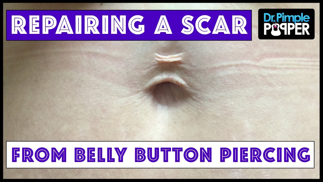 Fixing a Belly Button with Hips that Don’t Lie!!