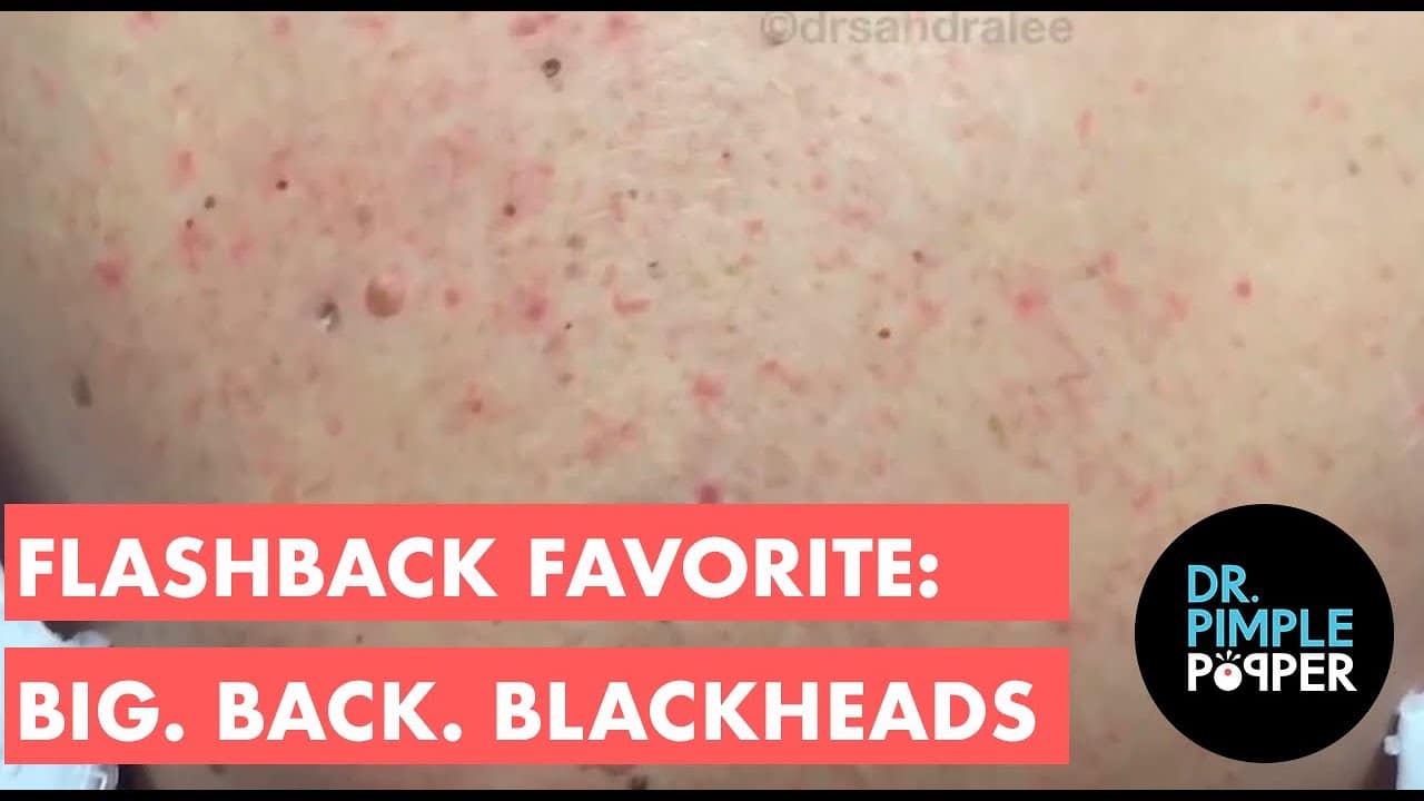 FlashBack Favorite: Big. Back. Blackheads!