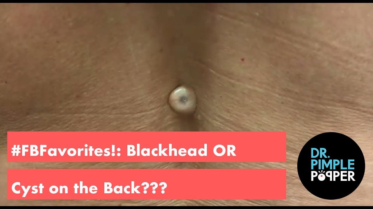 FlashBack Favorite: Blackhead or Cyst on the Back??