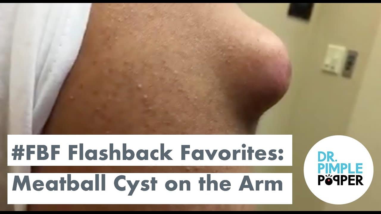 Flashback Favorites: Meatball Cyst on the Shoulder!