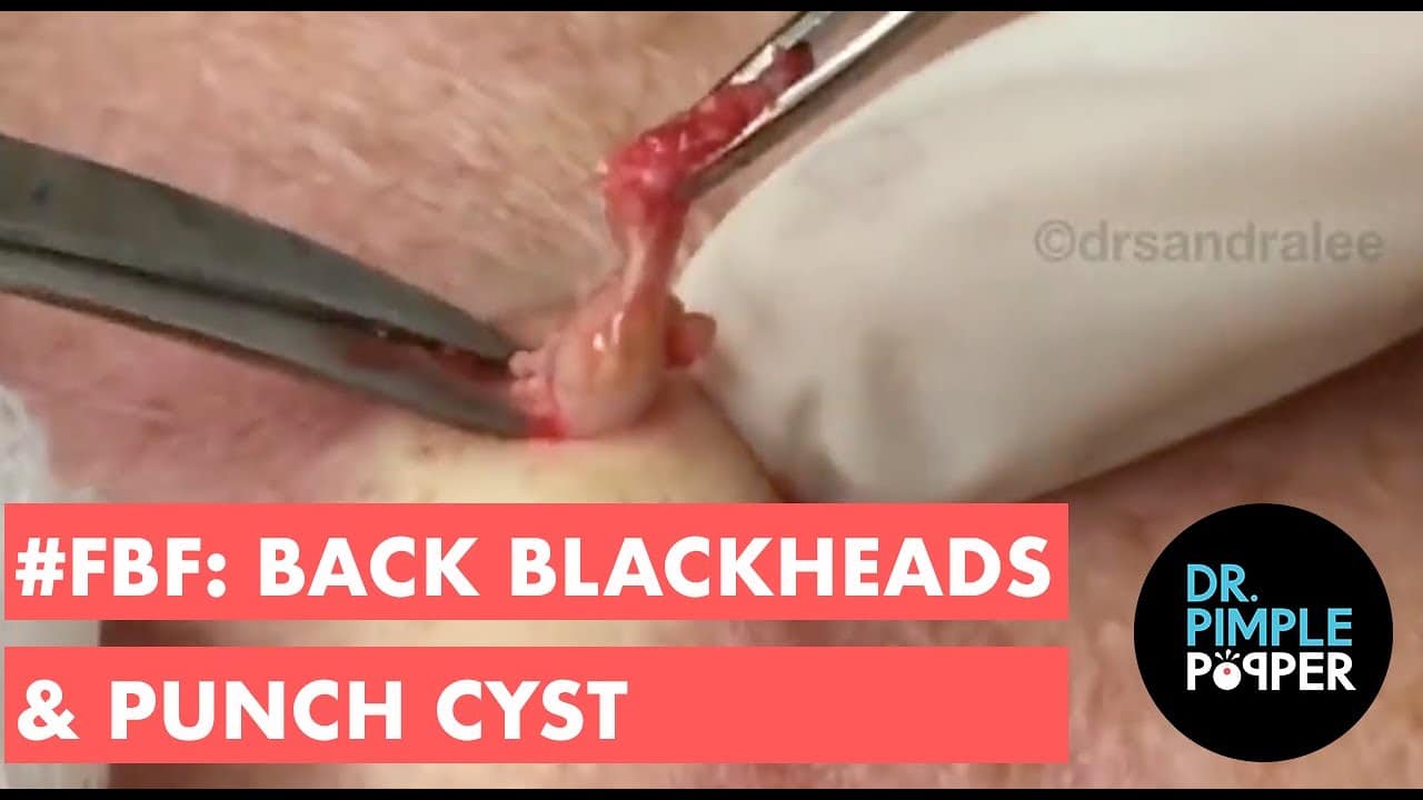 #FlashBackFavorite: Back Blackheads & A Cyst Punch