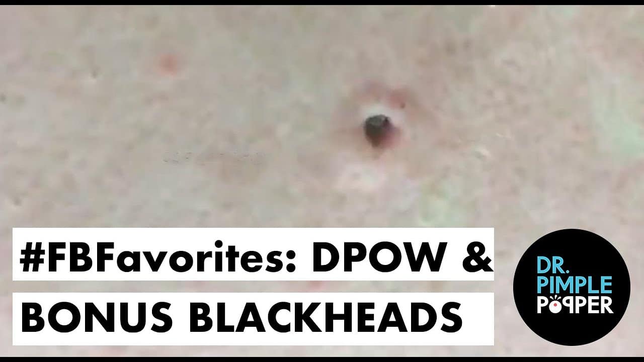 FlashBackFavorites: Dilated Pore of Winer & Bonus Blackheads!
