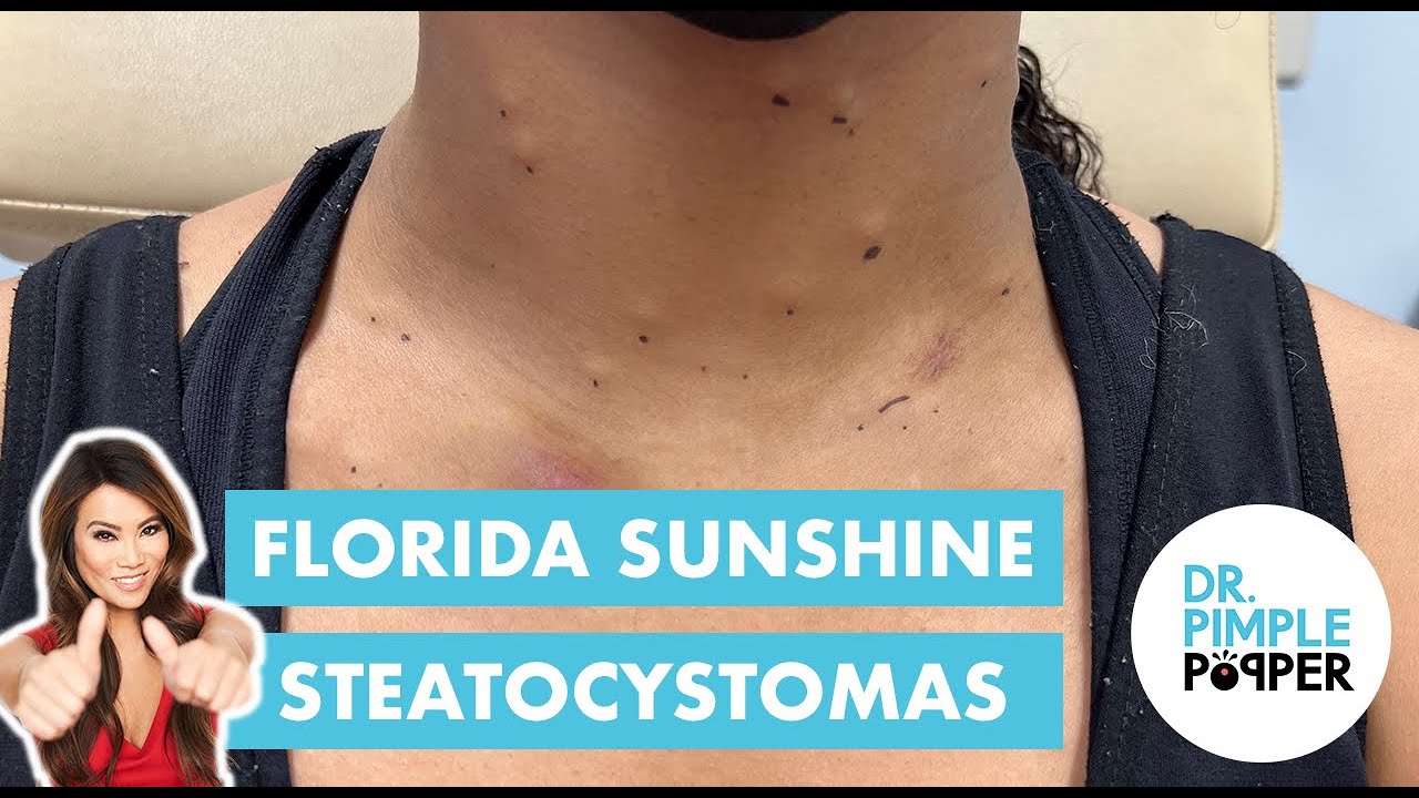 Florida Sunshine Steatocystomas