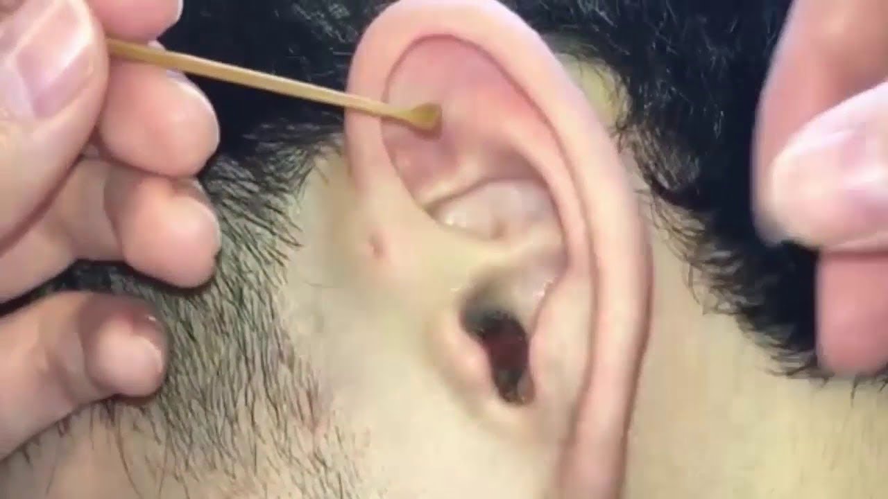 FLYING PIMPLES IN EARS POPPING PIMPLE IN EAR