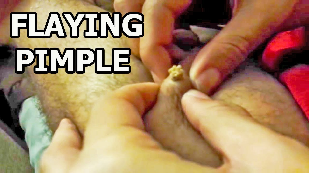 FLYING PIMPLES IN LEG  (POPPING PIMPLE IN LEG)