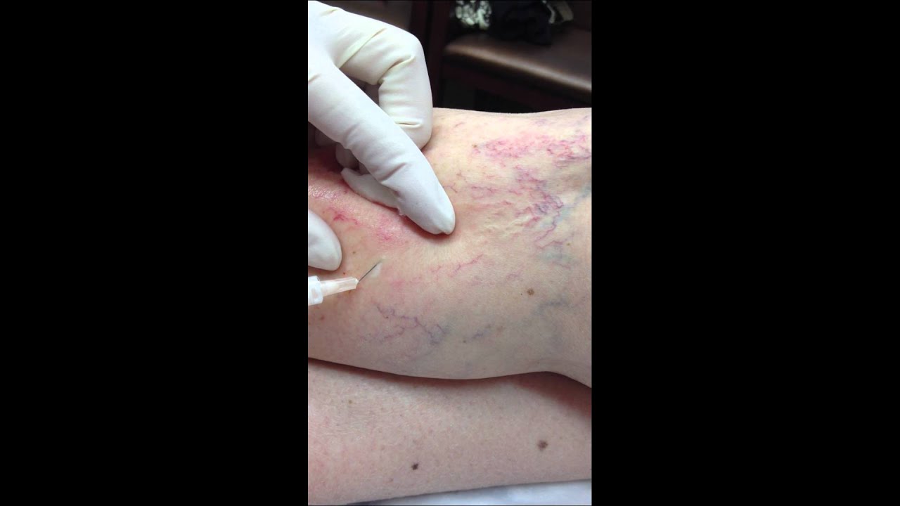 Foam Sclerotherapy with Asclera