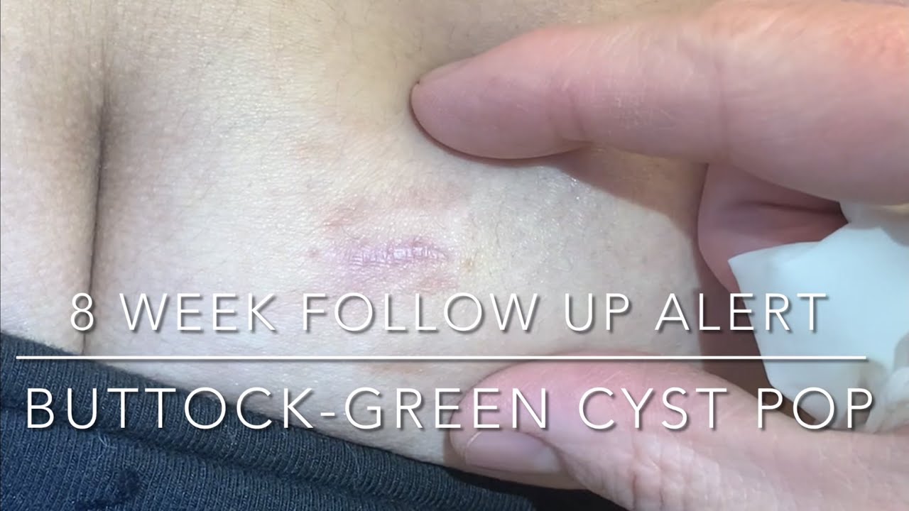 Follow up alert! Green juicy cyst pop on buttock-8 week follow up. Healed great, patient very happy!