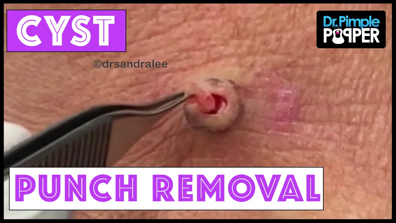 Follow up and a New Cyst Punch from “Big Back Blackheads”