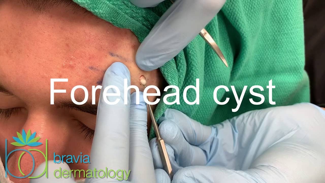 Forehead cyst contents popped out