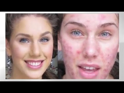 Foundation Routine For Acne | How To Cover Pimples, Scars, Cystic Acne, Blackheads & Oil