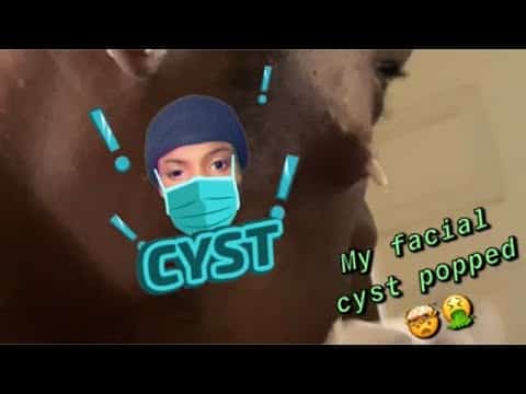 FreewayyFilmz ep. 5 | My Cyst Popped IN MY SLEEP ??!!!