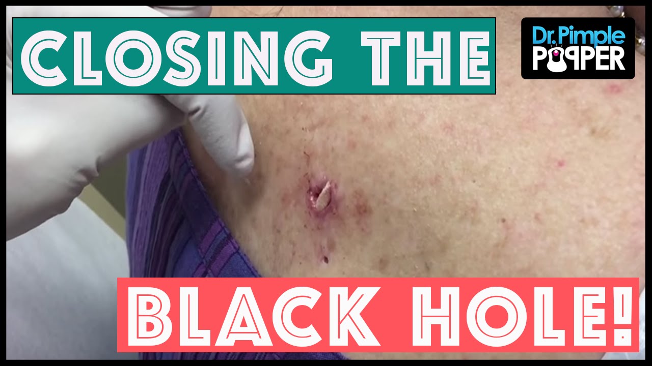 From “Big Back Blackheads”: Closing The Black Hole