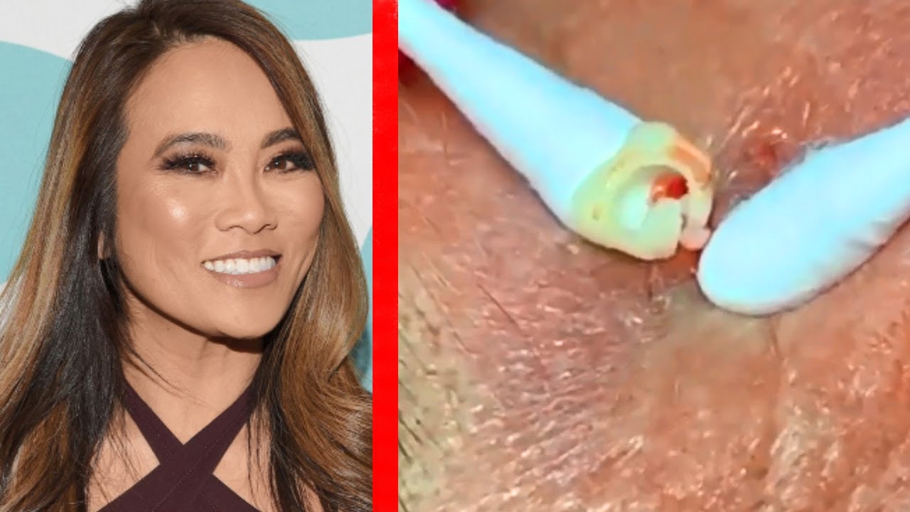From Dr. Vikram to Dr. Sandra Lee!  History of Pimple Popping (Text)