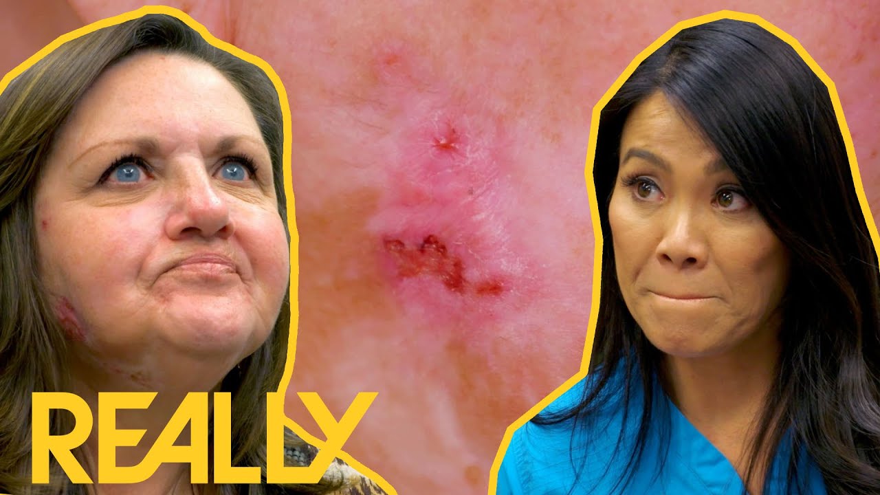 Frustrated Patient Disagrees With Dr. Lee's Diagnosis! | Dr. Pimple Popper