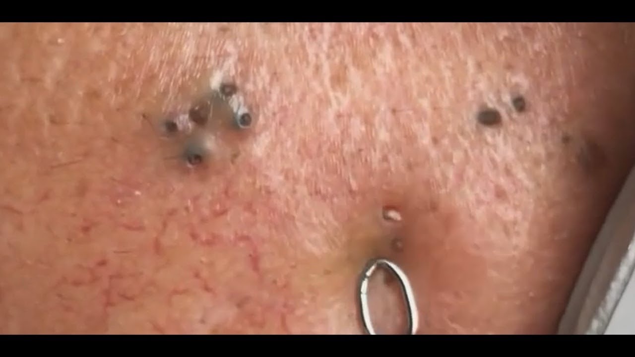 Full Blackhead Popping Video – HOT 2019 – Part #76