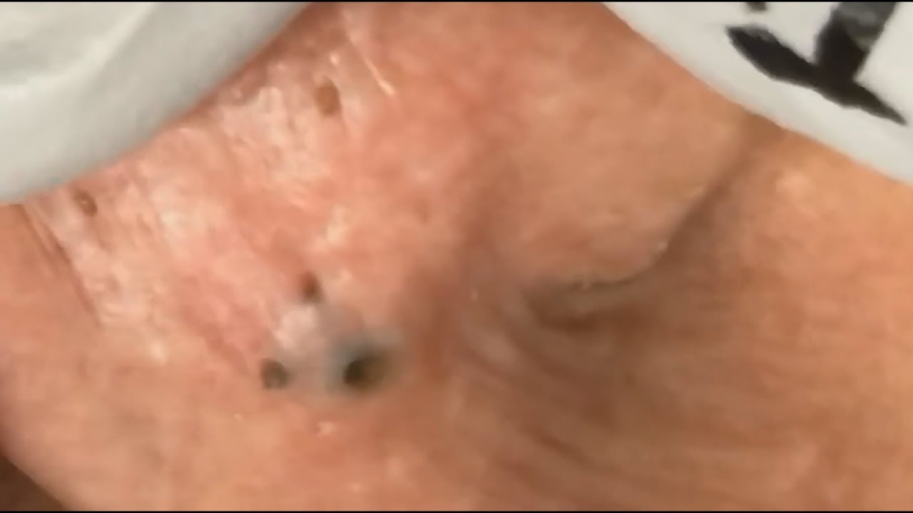 Full Blackhead Popping Video – HOT 2019 – Part #73