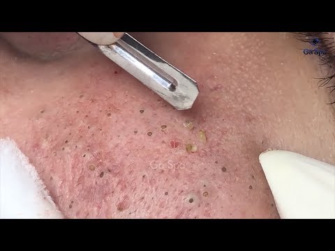 Full Blackhead Popping Video – HOT 2019 – Part 2 – Continue