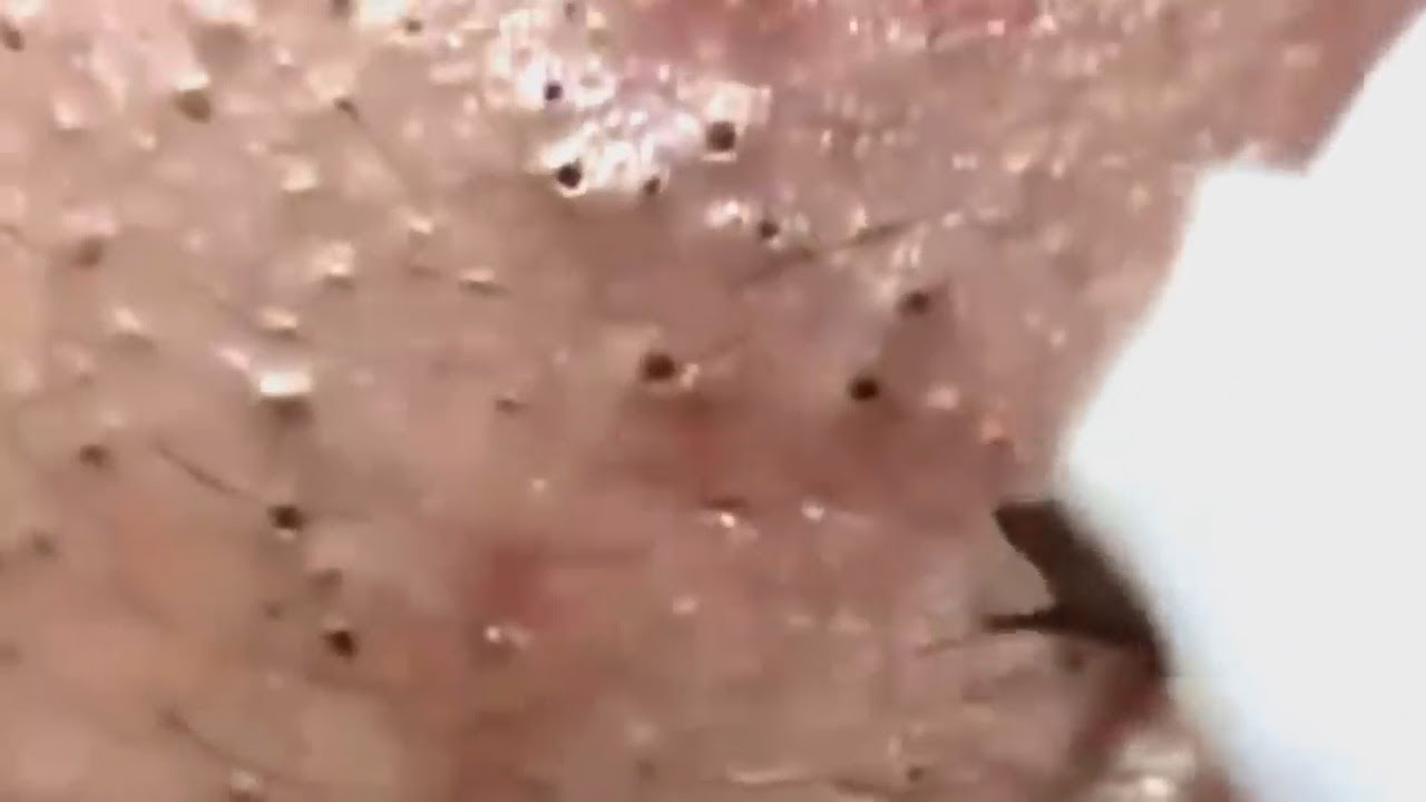 Full Blackhead Popping Video   HOT 2019   Part 116