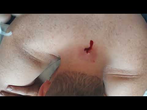 Full Version of Massive Cyst Explosion