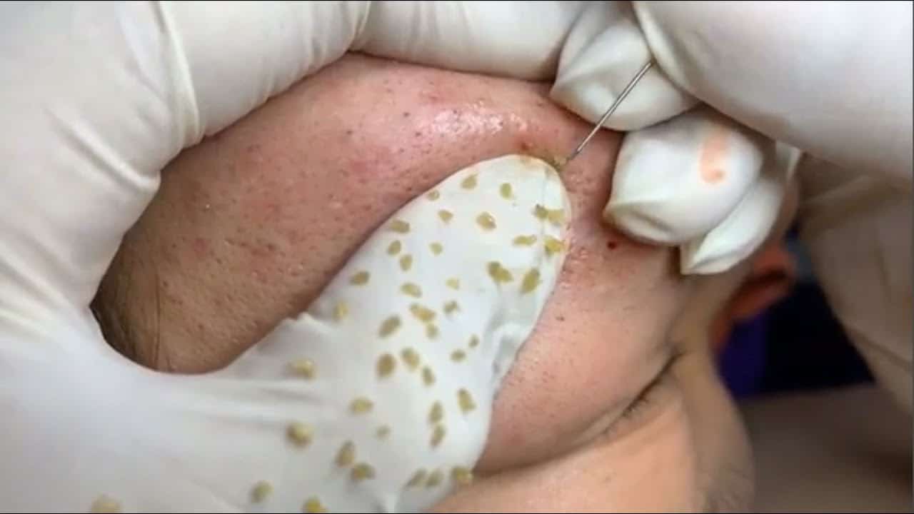 FULL VIDEO ACNE TREATMENT AMAZING | BEST BLACKHEADS REMOVAL | PIMPLE POPPING