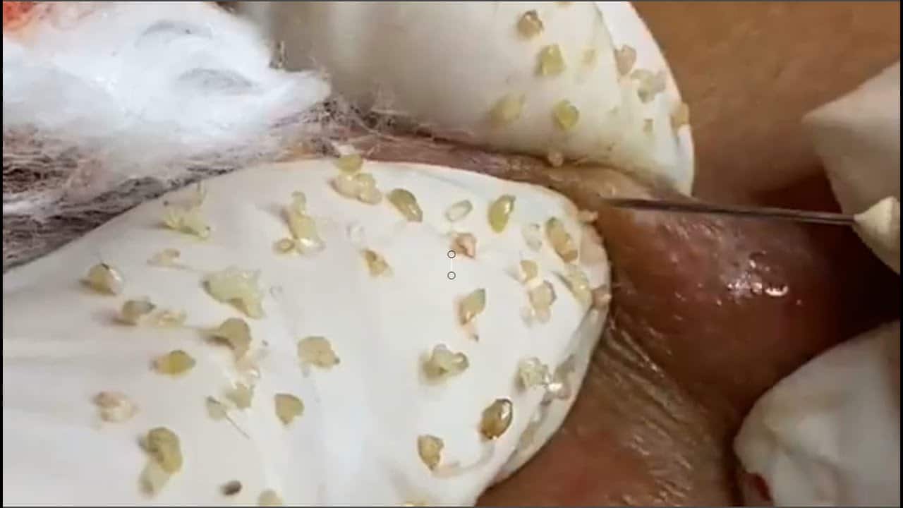 FULL VIDEO AMAZING BLACKHEADS REMOVAL | BEST ACNE TREATMENT | NICE PIMPLE POPPING