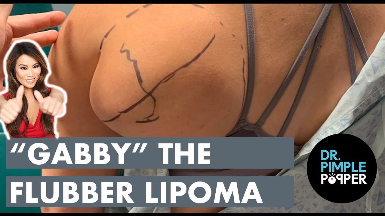 “Gabby” the Flubber Lipoma