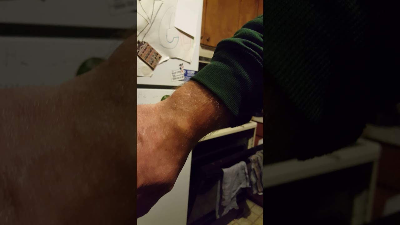 Ganglion cyst popping recurent wrist cyst popped with book