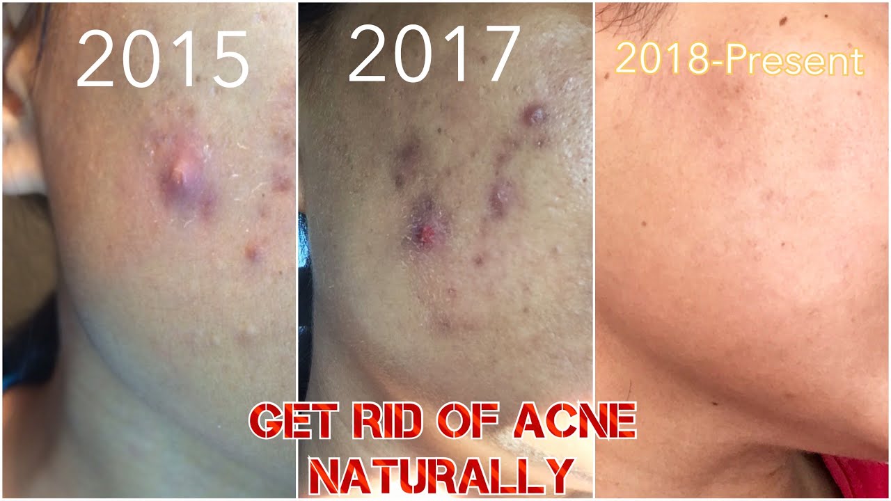 Get rid of Acne Forever NATURALLY! | Cystic Acne natural cure