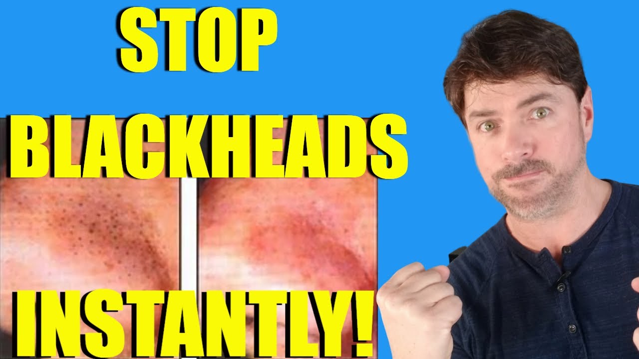 Get Rid Of Blackheads Instantly | Forever! | Chris Gibson