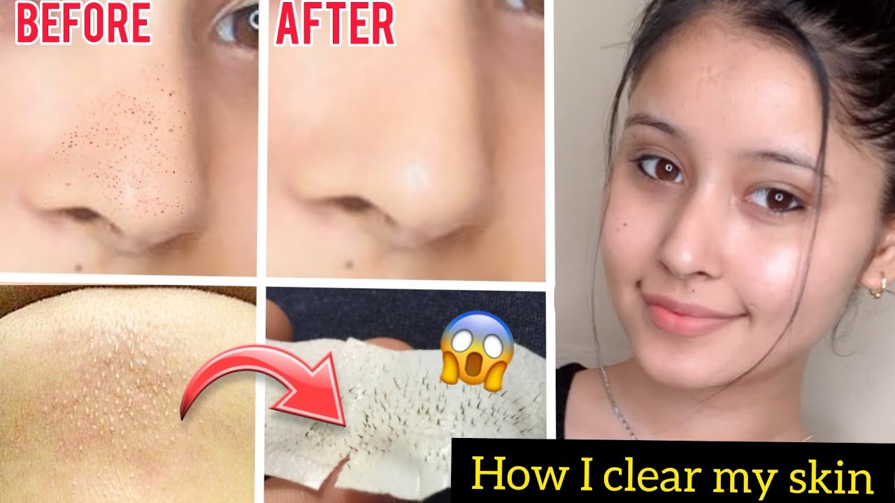 Get Rid of Blackheads/Whiteheads/ Clogged Pores ?|Just in 1 day| DEEP CLEANSING ROUTINE