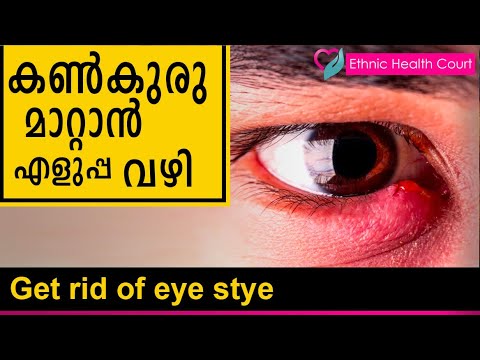 Get rid of eye stye | കൺകുരു മാറ്റാൻ എളുപ്പ വഴി  | Ethnic Health Court