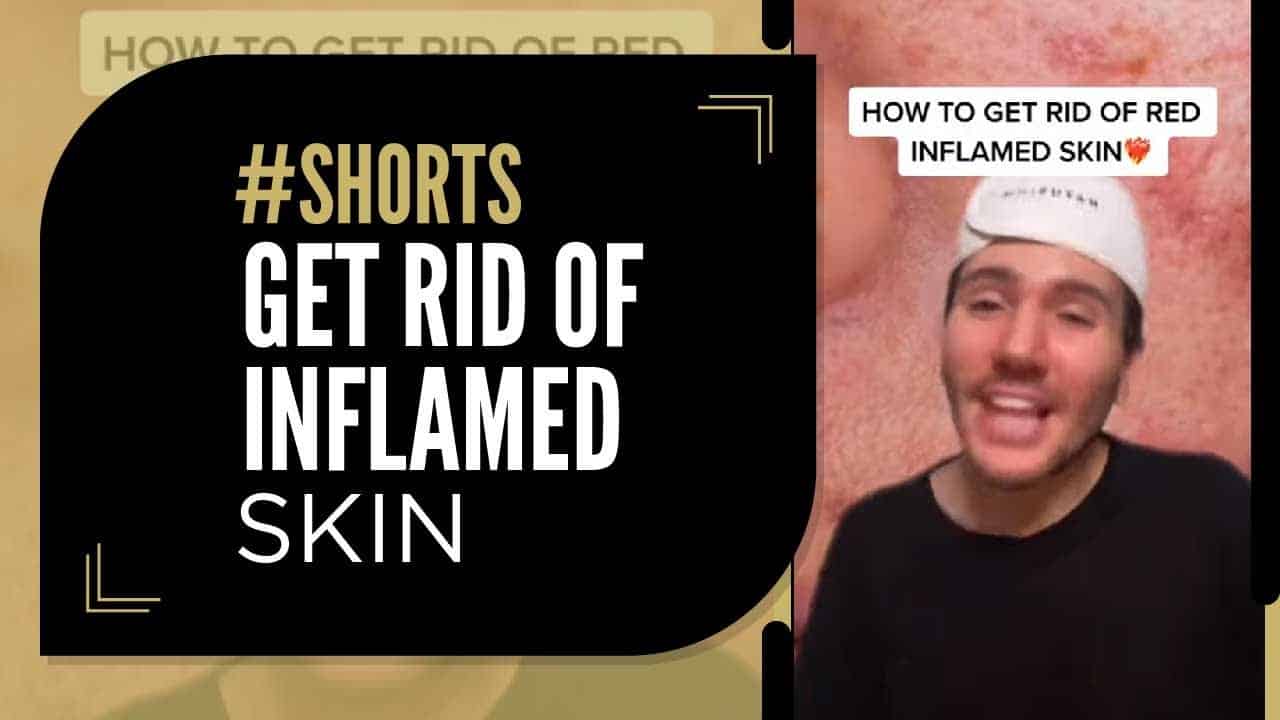 Get Rid of Inflamed Skin