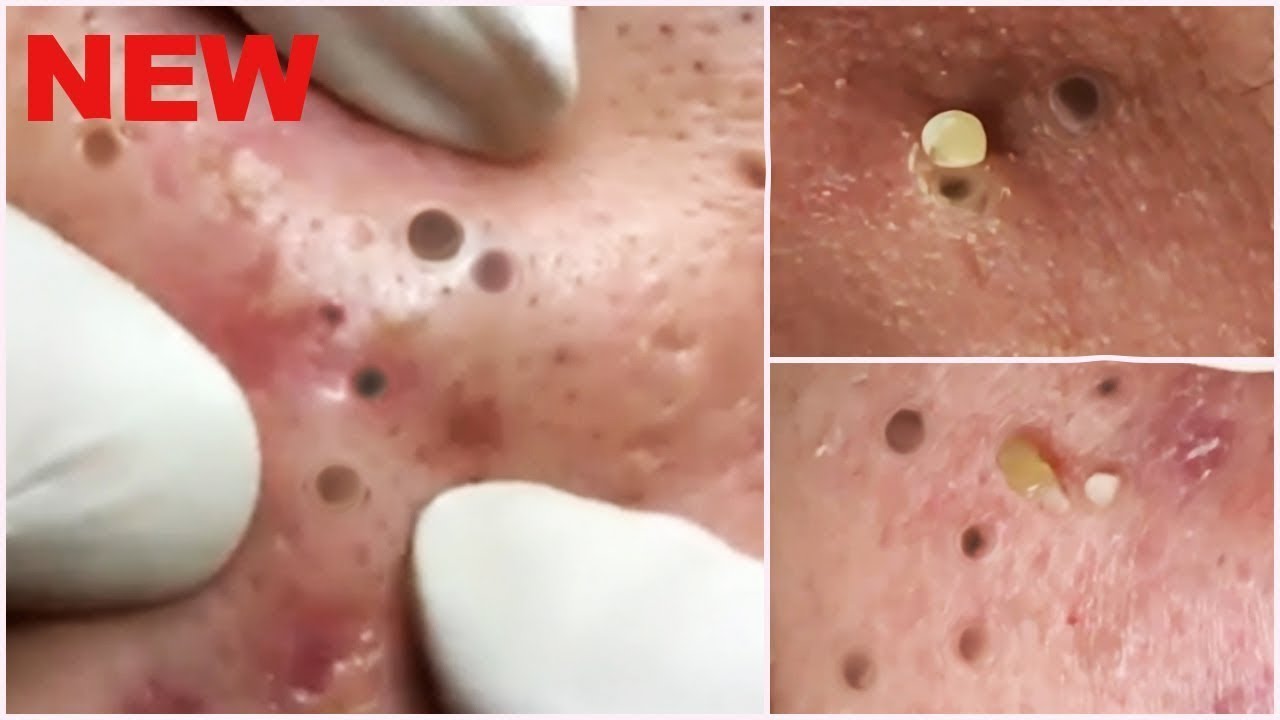 GIANT BLACKHEAD EXTRACTION #acne #blackheads#whiteheads, #Treatments #pimple# Full Screen HD PART2