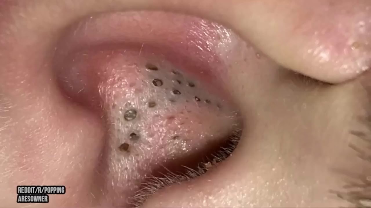 GIANT BLACKHEAD EXTRACTION #acne #blackheads#whiteheads, #Treatments #pimple# Full Screen HD PART3