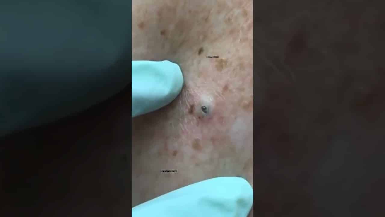 GIANT Blackhead removed from the Back! w/ Dr. Pimple Popper #shorts